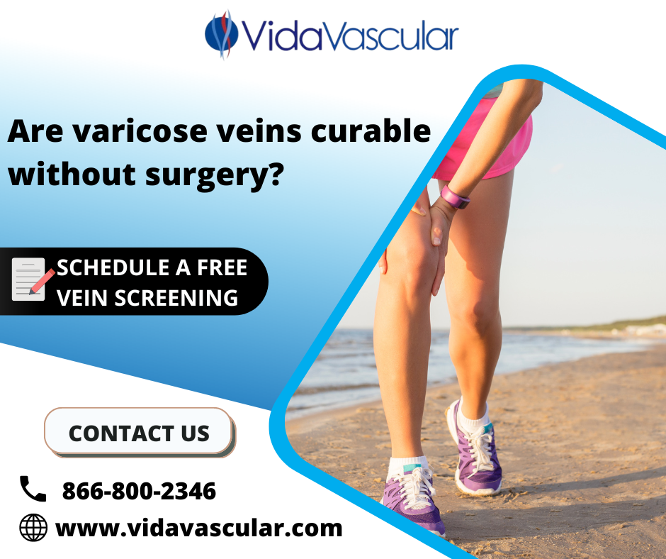 Are Varicose Veins Curable Without Surgery?
