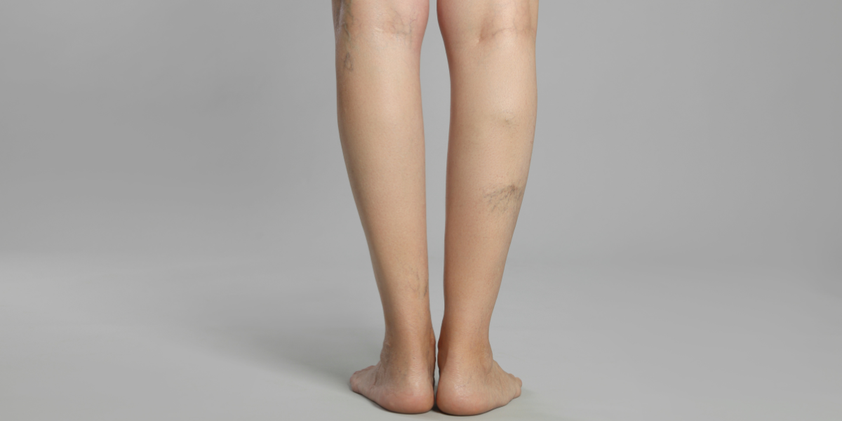 The Link Between Weight Gain and Varicose Veins