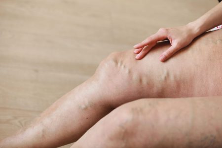 Painful varicose and spider veins on active womans legs, self-helping herself in overcoming the pain. Vascular disease, varicose veins problems